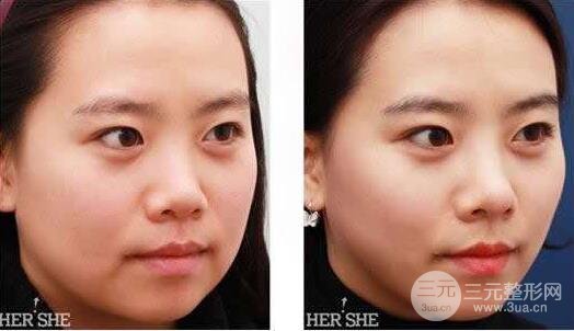 面部吸脂大概要多少钱？面部吸脂减肥价格表和前后果图片