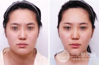 面部吸脂大概要多少钱？面部吸脂减肥价格表和前后果图片