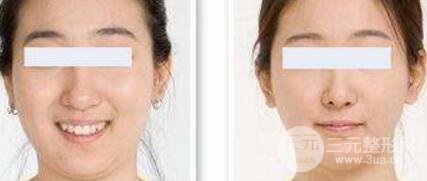 面部吸脂大概要多少钱？面部吸脂减肥价格表和前后果图片