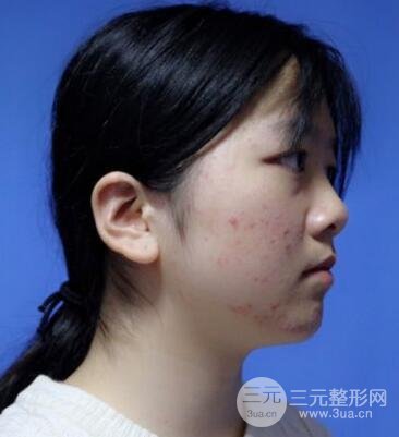 怎样减掉双下巴？双下巴吸脂后个人经历 价格略贵但果好