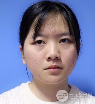 怎样减掉双下巴？双下巴吸脂后个人经历 价格略贵但果好