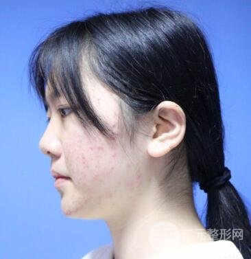 怎样减掉双下巴？双下巴吸脂后个人经历 价格略贵但果好