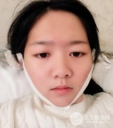 怎样减掉双下巴？双下巴吸脂后个人经历 价格略贵但果好