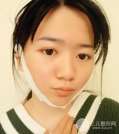 怎样减掉双下巴？双下巴吸脂后个人经历 价格略贵但果好