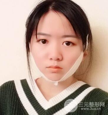 怎样减掉双下巴？双下巴吸脂后个人经历 价格略贵但果好