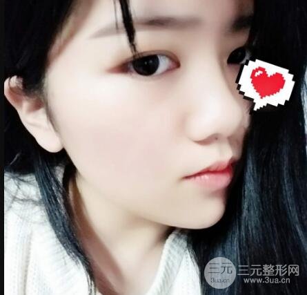 怎样减掉双下巴？双下巴吸脂后个人经历 价格略贵但果好