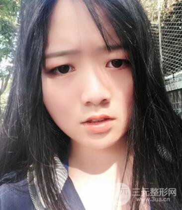 怎样减掉双下巴？双下巴吸脂后个人经历 价格略贵但果好