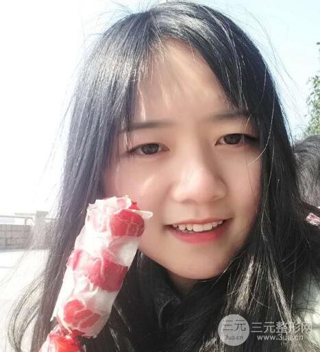 怎样减掉双下巴？双下巴吸脂后个人经历 价格略贵但果好