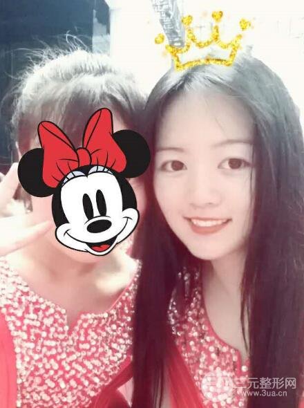 怎样减掉双下巴？双下巴吸脂后个人经历 价格略贵但果好