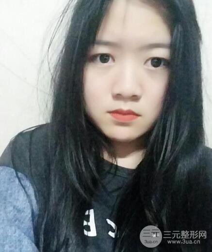 怎样减掉双下巴？双下巴吸脂后个人经历 价格略贵但果好