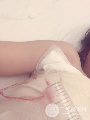 珠海莱茵门诊部卢刚医生假体隆胸真实案例，还有前后对比照片哟