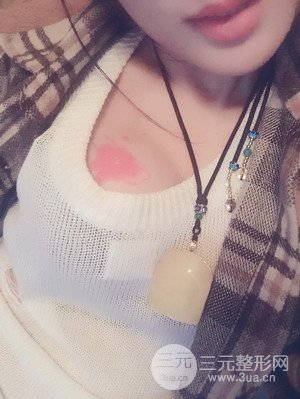 珠海莱茵门诊部卢刚医生假体隆胸真实案例，还有前后对比照片哟