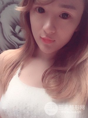 珠海莱茵门诊部卢刚医生假体隆胸真实案例，还有前后对比照片哟