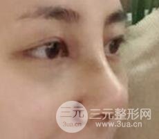 耳软骨垫鼻尖+假体隆鼻恢复过程实例和价格图片分享