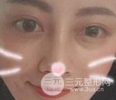 耳软骨垫鼻尖+假体隆鼻恢复过程实例和价格图片分享