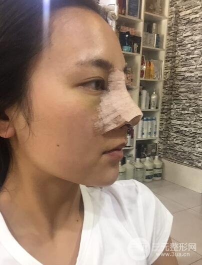 耳软骨垫鼻尖+假体隆鼻恢复过程实例和价格图片分享