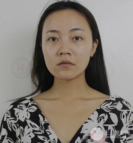 耳软骨垫鼻尖+假体隆鼻恢复过程实例和价格图片分享