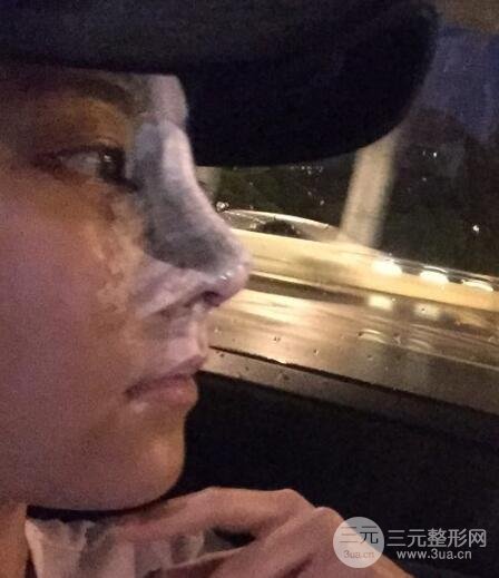 耳软骨垫鼻尖+假体隆鼻恢复过程实例和价格图片分享
