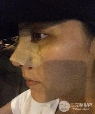 耳软骨垫鼻尖+假体隆鼻恢复过程实例和价格图片分享