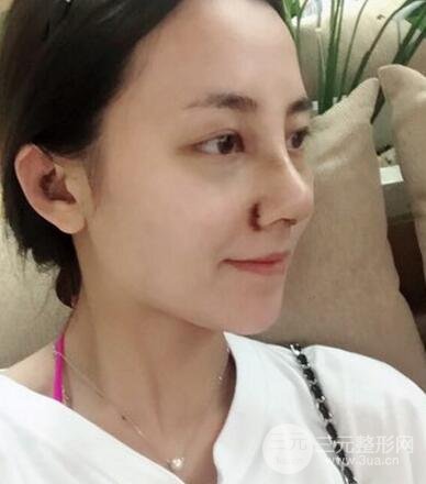 耳软骨垫鼻尖+假体隆鼻恢复过程实例和价格图片分享