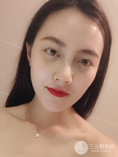 耳软骨垫鼻尖+假体隆鼻恢复过程实例和价格图片分享