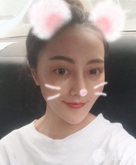 耳软骨垫鼻尖+假体隆鼻恢复过程实例和价格图片分享