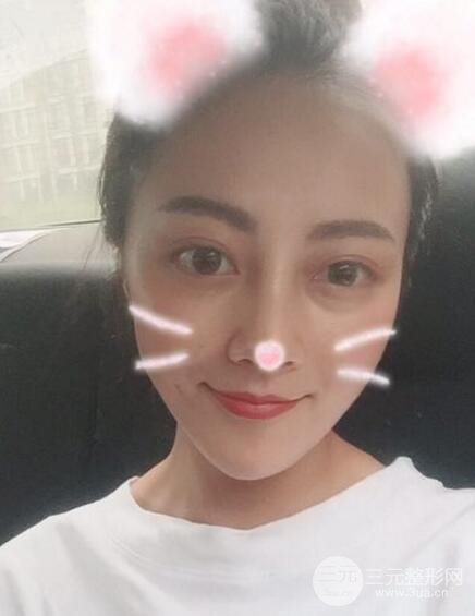 耳软骨垫鼻尖+假体隆鼻恢复过程实例和价格图片分享