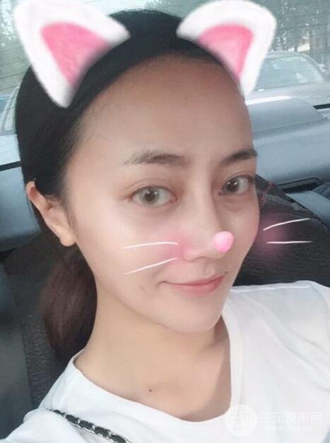 耳软骨垫鼻尖+假体隆鼻恢复过程实例和价格图片分享