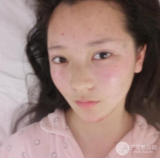 长得太着急是怎样一种体验？妹子血泪分享自体脂肪填充详细部年轻化经验
