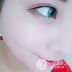 切开双眼皮对比恢复过程图 青岛琅梵亚美妍双眼皮案例