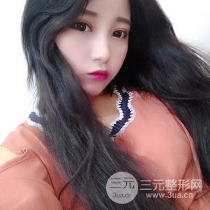 切开双眼皮对比恢复过程图 青岛琅梵亚美妍双眼皮案例