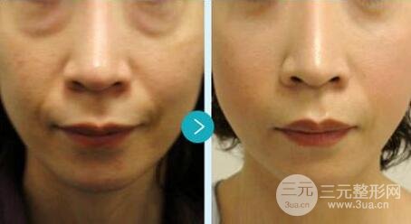 光子嫩肤多少钱一次？一般做几次有果？