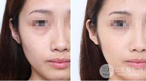 光子嫩肤多少钱一次？一般做几次有果？