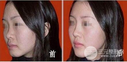 光子嫩肤多少钱一次？一般做几次有果？