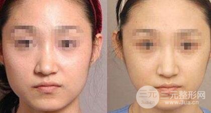 B****多少钱一次？打几次能定型？