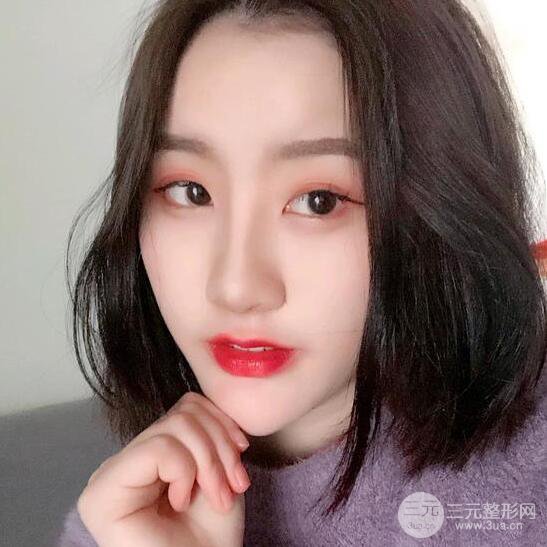 膨体隆鼻三十天恢复记录，术前术后对比图片曝光