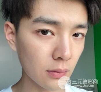 高强度聚焦超声面b提升术多少钱?亲身经历案例