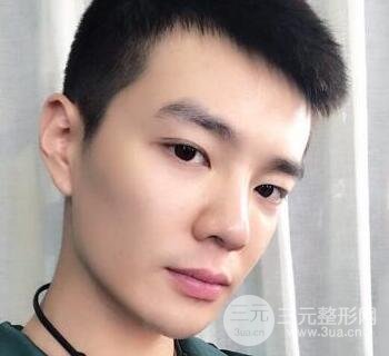 高强度聚焦超声面b提升术多少钱?亲身经历案例