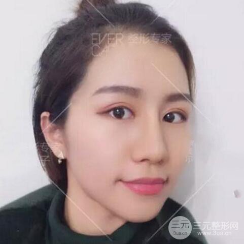 割欧式双眼皮价格和案例