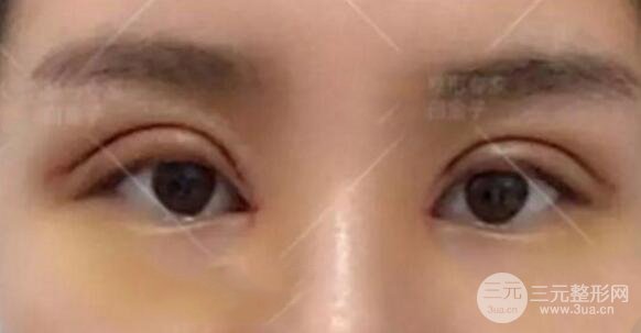 割欧式双眼皮价格和案例