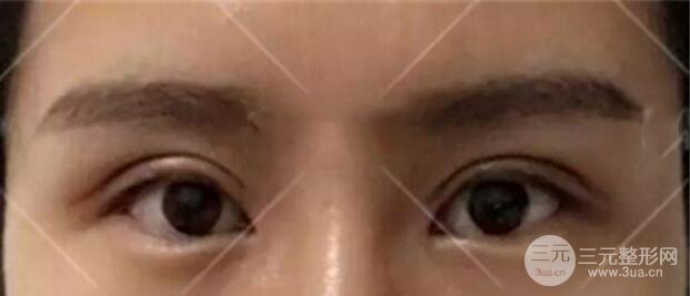 割欧式双眼皮价格和案例