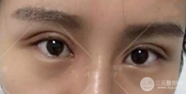 割欧式双眼皮价格和案例