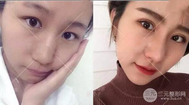 割欧式双眼皮价格和案例