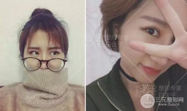 割欧式双眼皮价格和案例