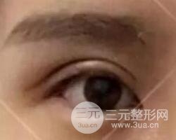 割欧式双眼皮价格和案例