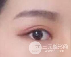 割欧式双眼皮价格和案例