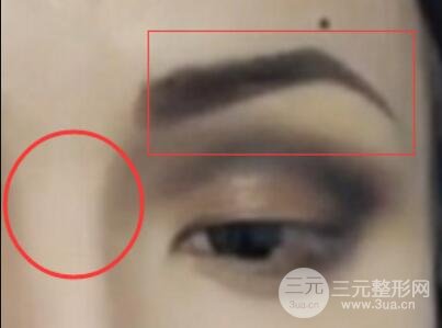 做欧式双眼皮价格和需要满足5个条件果才好