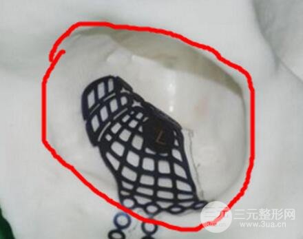 做欧式双眼皮价格和需要满足5个条件果才好