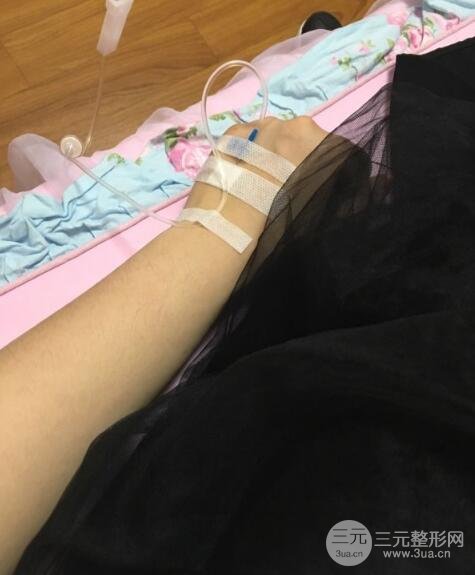 隆鼻整形包括假体隆鼻+耳软骨垫鼻尖+鼻小柱延长