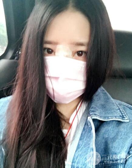 隆鼻整形包括假体隆鼻+耳软骨垫鼻尖+鼻小柱延长